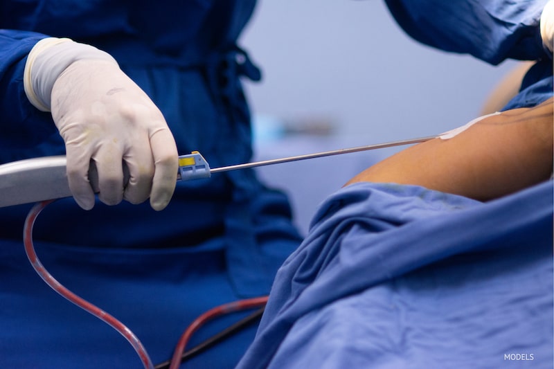 is liposuction painful?