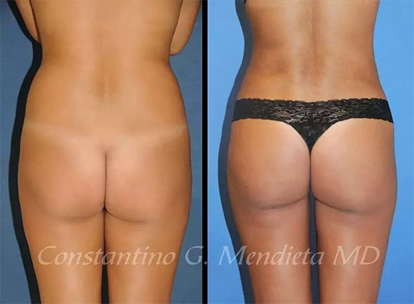 Brazilian Butt Lift surgery Miami