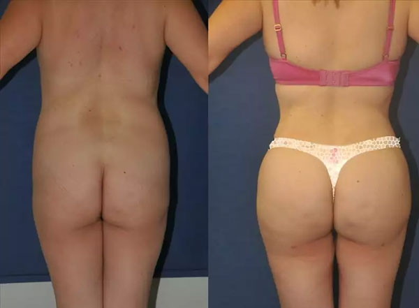 bbl surgeons Miami