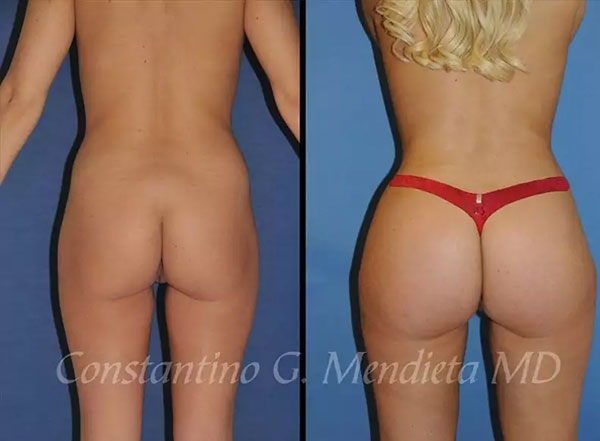 Miami Brazilian Butt Lift