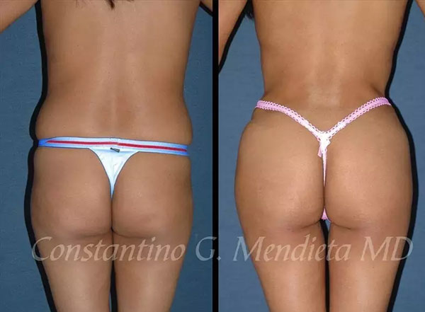 bbl Miami surgeons