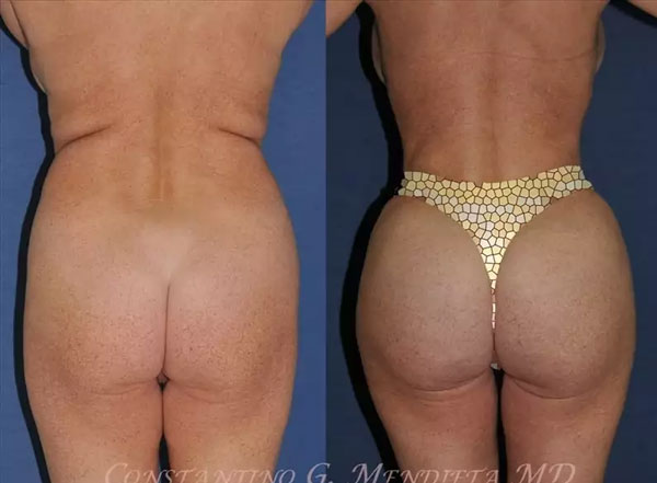 Brazilian Butt Lift in Miami FL