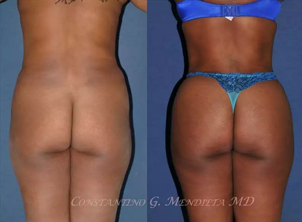 best BBL surgeons Miami
