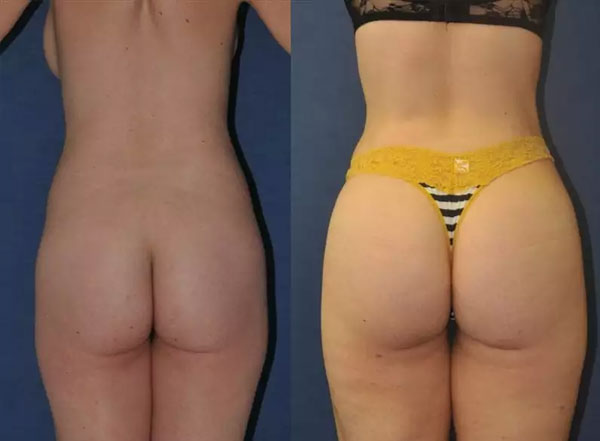 best Brazilian Butt Lift surgeon Miami